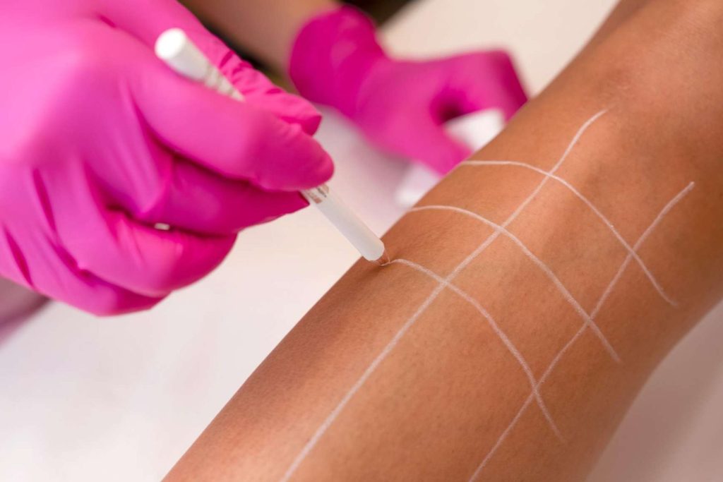 Πώς λειτουργεί η laser αποτρίχωση;
