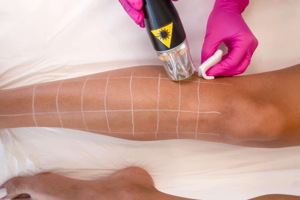 Διοδικό laser ή laser Αλεξανδρίτης; Ποιο είναι το καλύτερο laser αποτρίχωσης;
