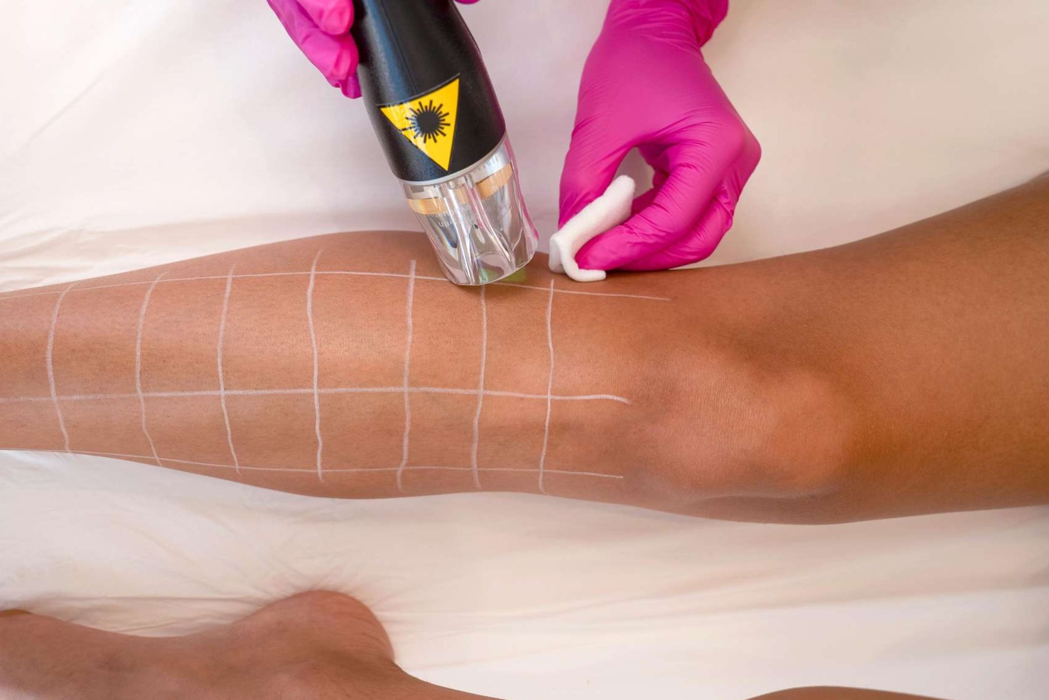 Κάθε πότε γίνεται η laser αποτρίχωση