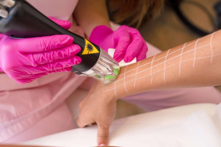 Ποσες συνεδριες laser αποτρίχωσης χρειάζονται