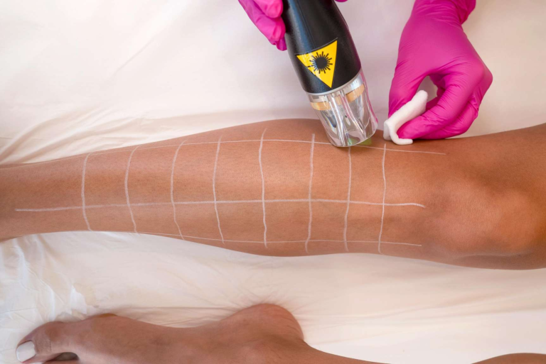 Πότε πέφτουν οι τριχες μετα το Laser;